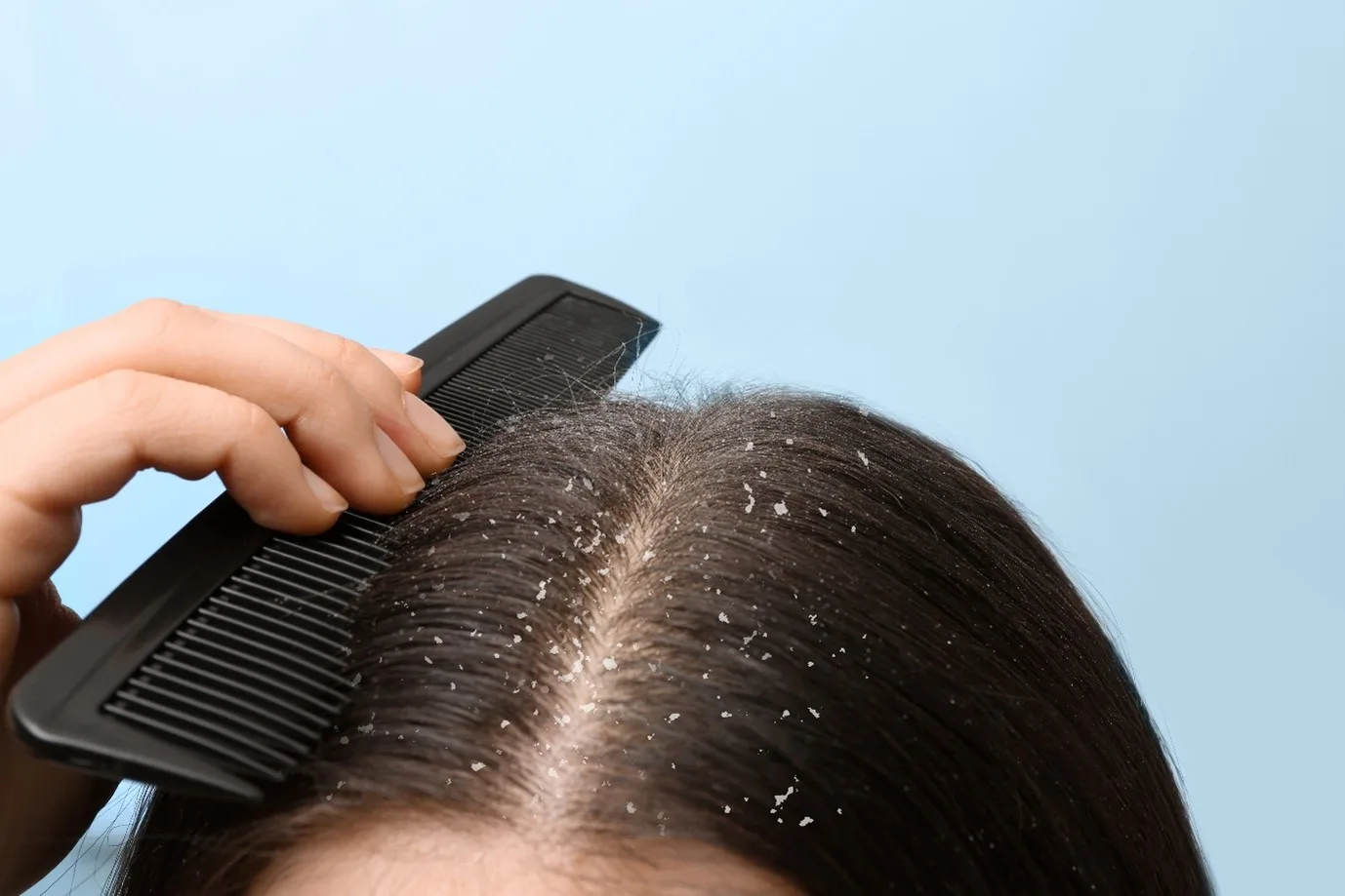 Dandruff Treatment2.webp